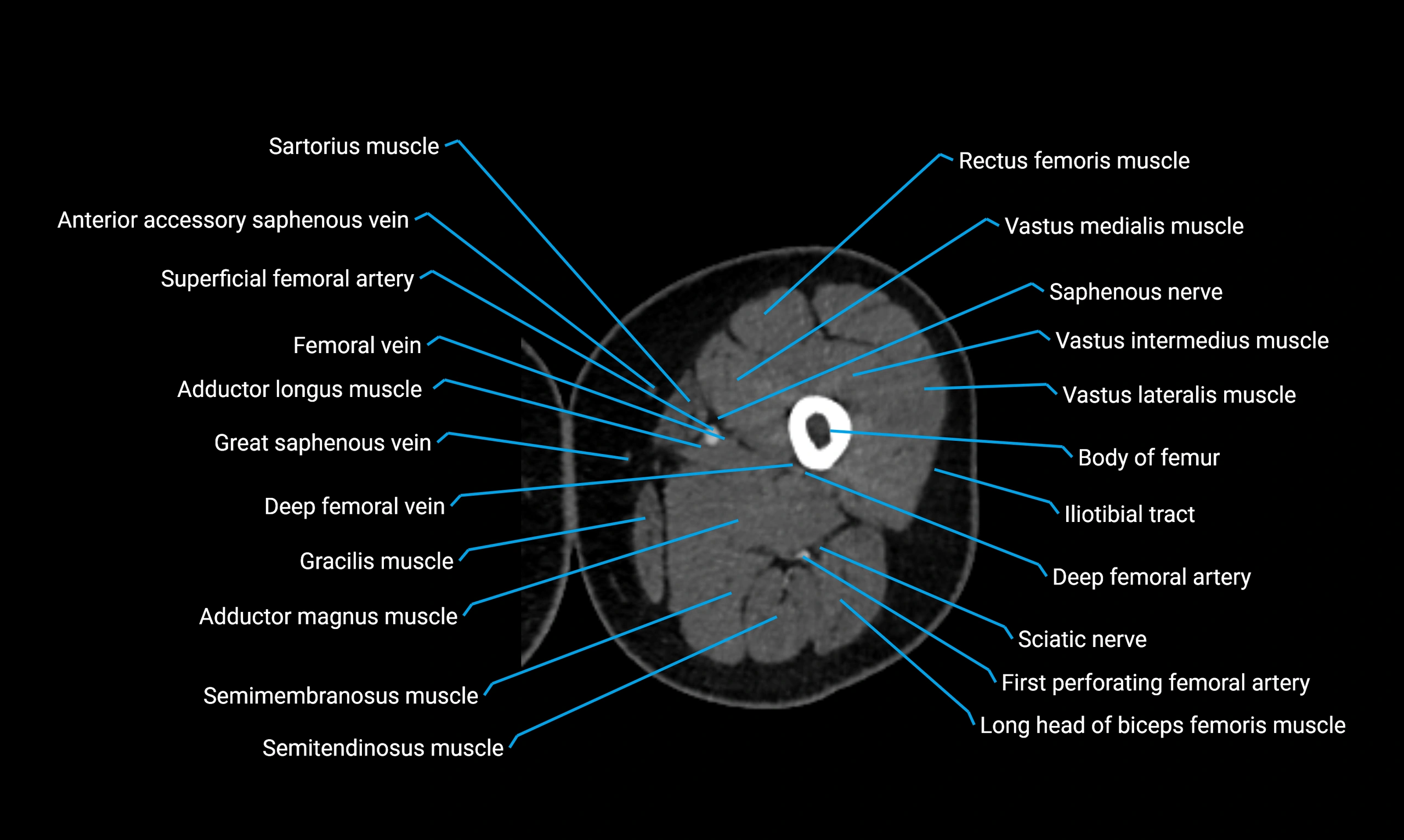 CT lower limb axial cross sectional anatomy labelled image 47 (2).webp